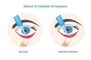 método do instilação do oftálmico. corrigir usar do olho gotas e oftálmico pomada.concept do olho tratamento, olho inflamação, olho fadiga, Cuidado, visão e saúde.vetor ilustração. vetor