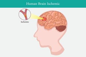 humano anatomia doença isquêmico acidente vascular encefálico vetor ilustração em branco fundo. eps 10