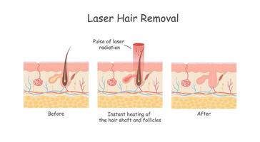 laser cabelo remoção do a pele camada contra cabelo. médico diagrama antes e depois de usando laser cabelo remoção. vetor