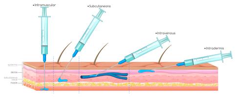Diagrama mostrando injeção com seringa