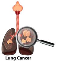 Um pulmão humano com câncer vetor
