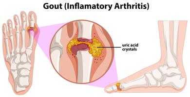 Uma anatomia humana da gota vetor