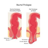 reto prolapso. dois tipos do proctológico doença. vetor