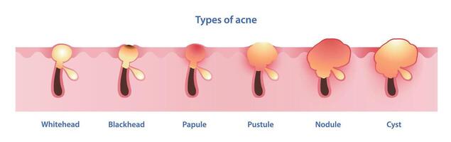 tipos do acne vetor em branco fundo. formação do não inflamatório acne, cabeça branca, cravo, inflamatório acne, pápula, pústula, nódulo e cisto. pele Cuidado e beleza conceito ilustração.