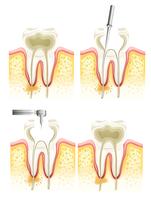 Processo de canal radicular vetor