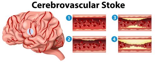 Diagrama mostrando estágios do AVC cerebrovascular vetor
