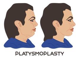 plastismoplastia. antes e depois de vetor