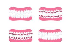 dentes com aparelho ortodôntico. ortodôntico tratamento. dente aparelho ortodôntico. dentes com metal colchetes vetor