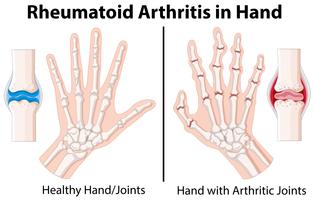Diagrama mostrando artrite reumatóide na mão vetor