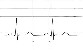 Preto e branco eletrocardiograma vetor