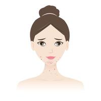 a mulher com acne em mandíbula e pescoço ilustração isolado em branco fundo. acne, espinhas, cravos, comedões, espinhas, pápula, pústula, nódulo, cisto em face e pescoço. vetor