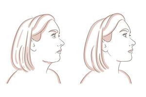 reduzir Duplo queixo, mandíbula plástico e cosmetologia. pegue livrar do face e pescoço gordo antes e depois de conceito. vetor