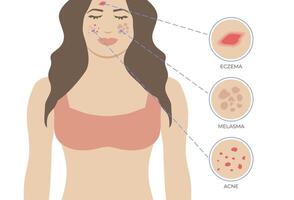 pele problemas eczema, acne e melasma. pele problemas com mulher ilustração vetor
