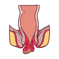 externo hemorróidas etapa 4 ilustração vetor