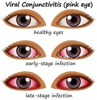 Conjuntivite viral nos olhos humanos vetor