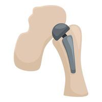 humano quadril articulação com protético implantar ilustração vetor