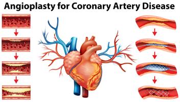 Diagrama mostrando angioplastia para doença arterial coronariana vetor