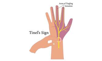 carpal túnel anatomia diagrama ilustração Projeto. vetor