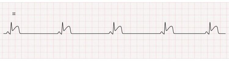 ekg monitor dentro conduzir ii mostrando seio bradicardia com tronco às inferior parede vetor