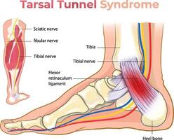 ilustração do tarso túnel síndrome diagrama vetor