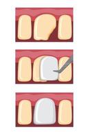 procedimento de dentes folheados, obturação dentária em vetor de ilustração plana de dente quebrado de desenho animado isolado no fundo branco
