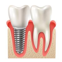 Modelo de Closeup de conjunto de dente de implante dentário vetor