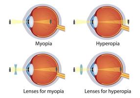 hipermetropia e miopia corrigidas por lentes. conceito de defeito nos olhos. correção de vários distúrbios da visão ocular por lentes. vetor