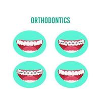 tratamento ortodôntico com aparelho dentário, etapas do processo de alinhamento dos dentes. ilustração vetorial em um estilo simples, isolado em um fundo branco. vetor