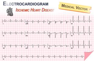 Eletrocardiograma (ECG, ECG) da Cardiopatia Isquêmica (Infarto do Miocárdio) e Anatomia do Coração icon vetor