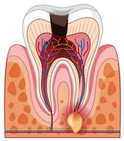 Uma cárie e cavidade do dente humano vetor