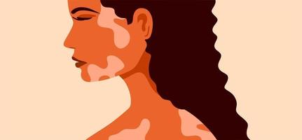 vitiligo é uma jovem com problemas de pele. doenças de pele. o conceito de dia mundial do vitiligo. diferentes cores de pele de personagens femininas. para um blog, artigos, banner, revista. vetor
