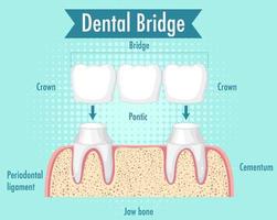 infográfico de humano na ponte dental vetor