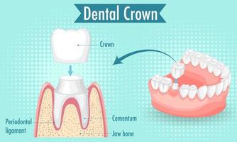 infográfico de humano na coroa dentária vetor