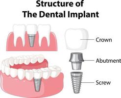 infográfico de humano na estrutura do implante dentário vetor