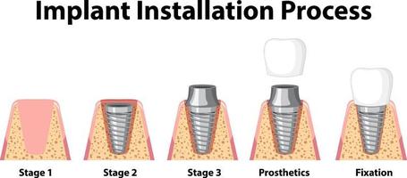 infográfico de humano no processo de instalação de implantes vetor