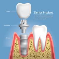 Dentes humanos e ilustração vetorial de implante dentário