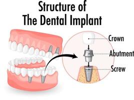 infográfico de humano na estrutura do implante dentário vetor