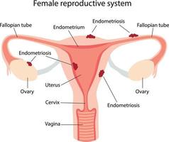 endometriose, ilustração esquemática das doenças do sistema reprodutor feminino vetor