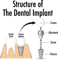 estrutura do implante dentário em fundo branco vetor