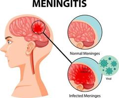 diagrama mostrando meningite no cérebro humano vetor