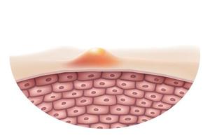Close-up de colisão de acne na superfície da pele