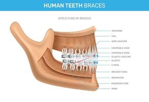 infográficos realistas de aparelhos de dentes humanos vetor