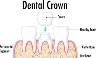 infográfico de humano na coroa dentária vetor