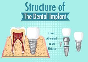 infográfico de humano na estrutura do implante dentário vetor