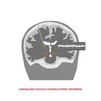 gravação cerebral no núcleo subtalâmico para cirurgia da doença de Parkinson. vetor