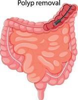 diagrama mostrando a remoção de pólipos vetor
