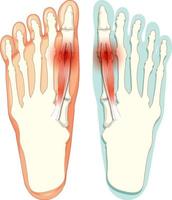 tipos de hallux valgus em fundo branco vetor