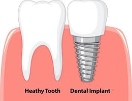 dente saudável e implante dentário em goma no fundo branco vetor