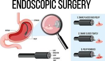 diagrama mostrando a cirurgia endoscópica vetor