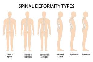 ilustração vetorial de deformidade da coluna. cifose, infográfico da coluna lordose. diagrama com curvatura da coluna e coluna saudável. defeito de postura. bandeira médica, educacional e científica. vetor